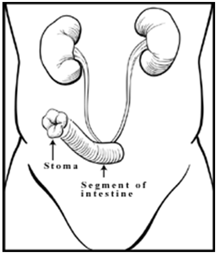 Bladder Obstruction Uro Care Chennai By Dr Nitesh Jain