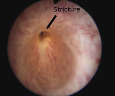 stricture-1.png