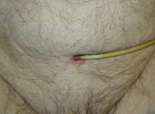 stricture-8.png