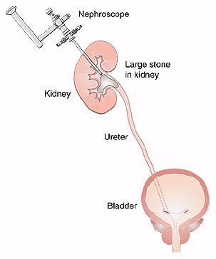 percutaneous-nephrolithotomy-pcnl.png