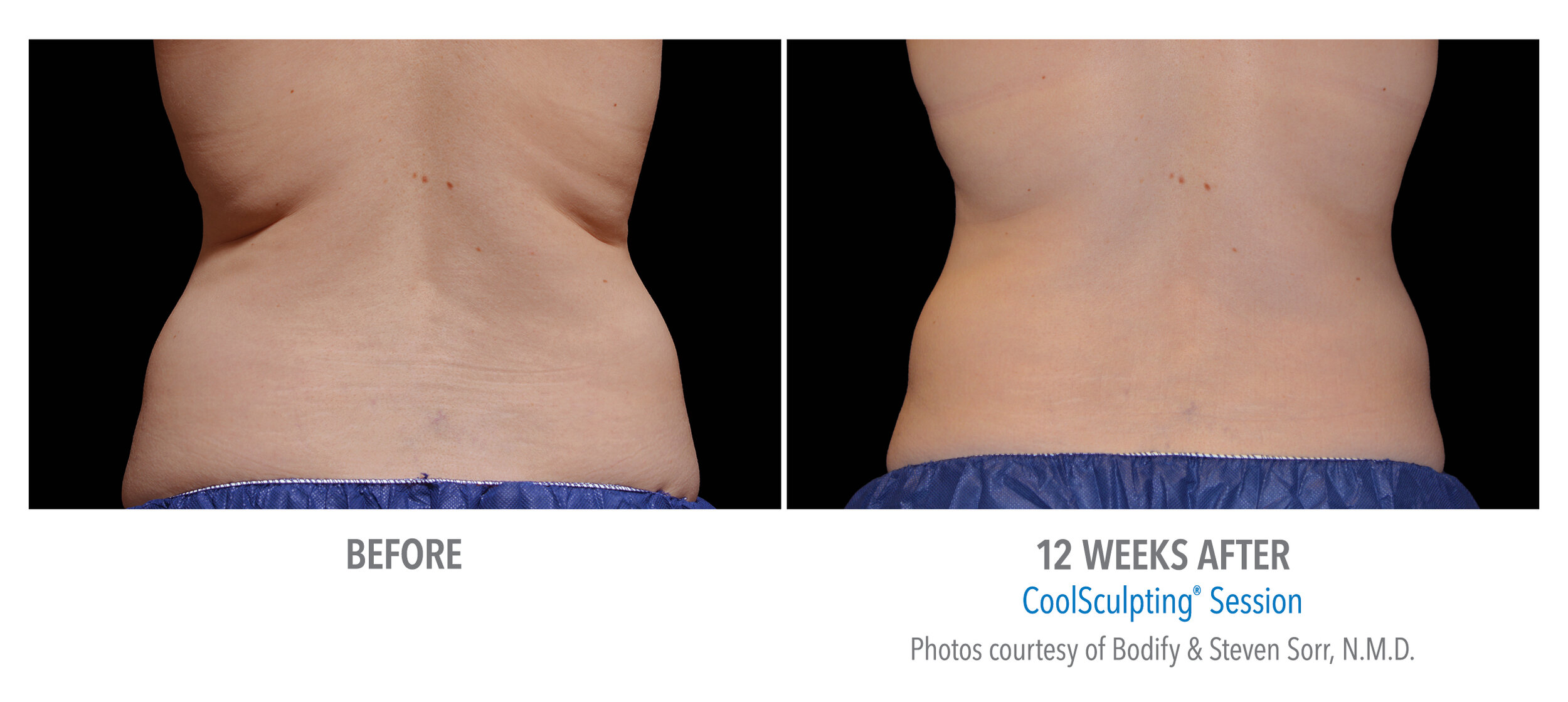 CoolSculpting Before and After 80