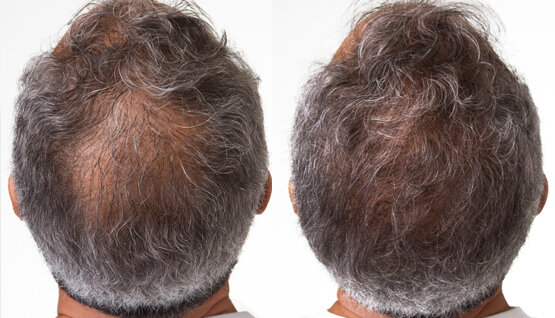 hair loss, hair thinning, men with thinning hair, women with thinning hair  — Ageless Esthetics Medspa