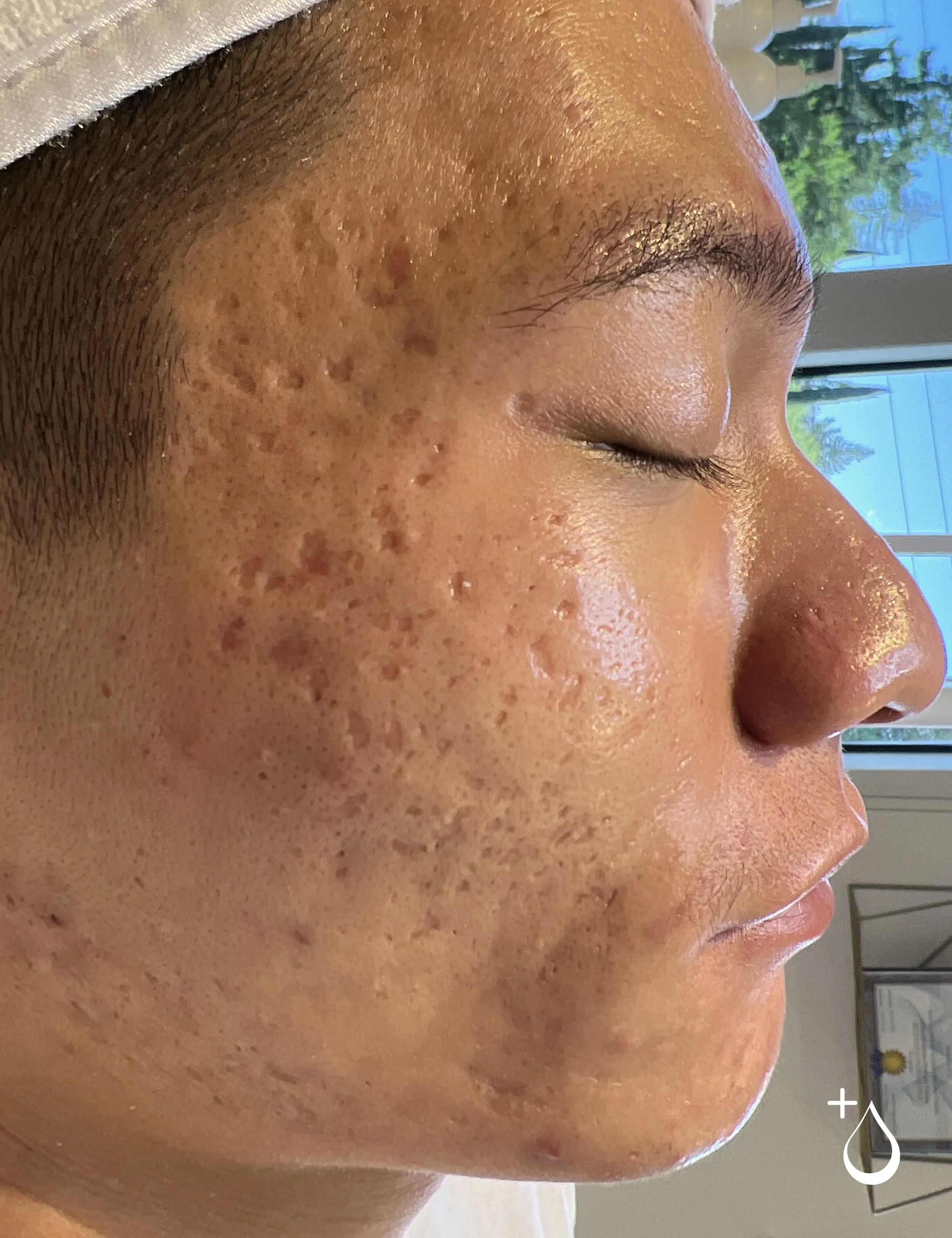 Close-up of a person's face showing acne and skin blemishes on their cheek, with a background of a window and trees outside.