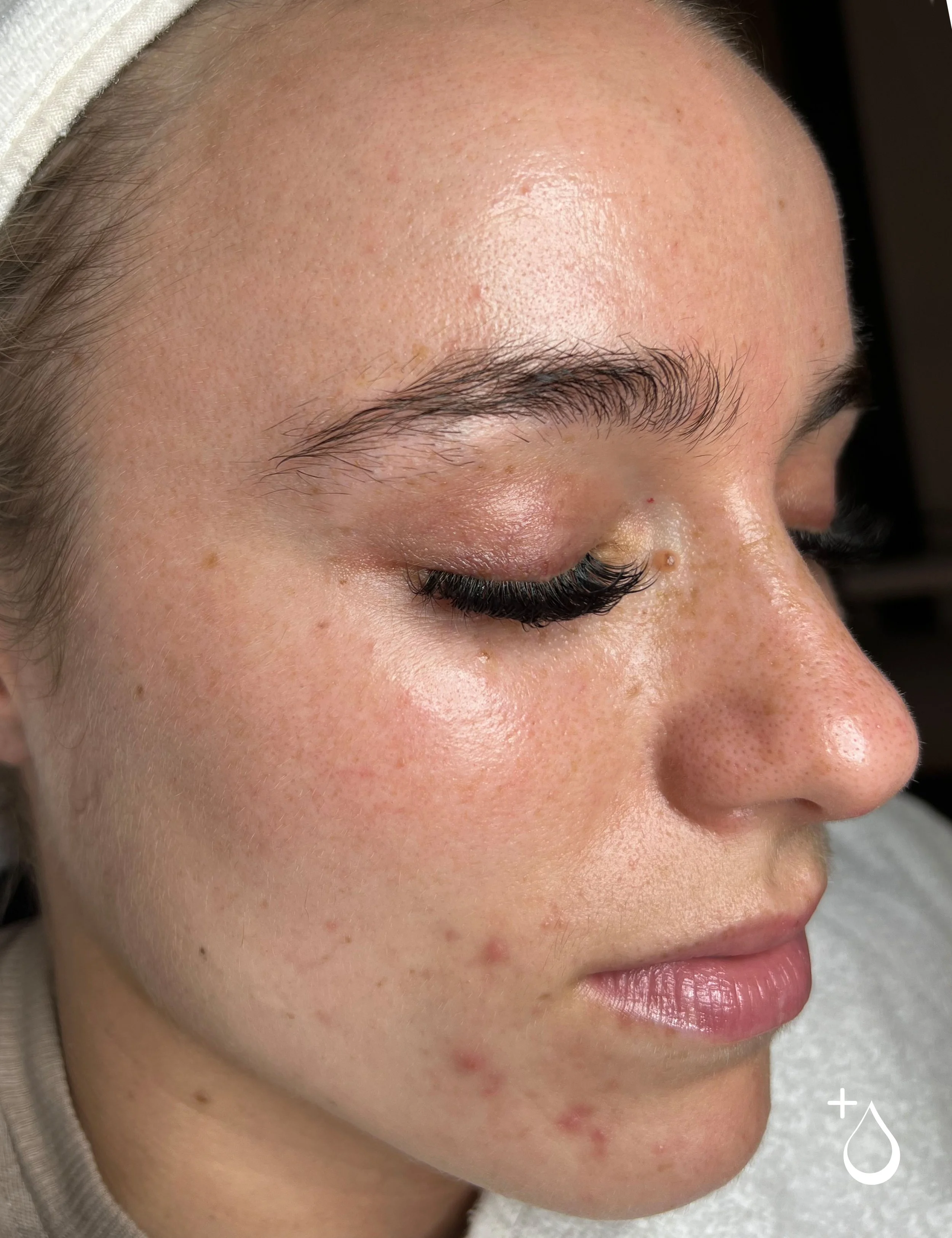 Close-up of a woman's face with clear skin, freckles, and some acne, with her eyes closed and makeup including mascara and natural lip color.