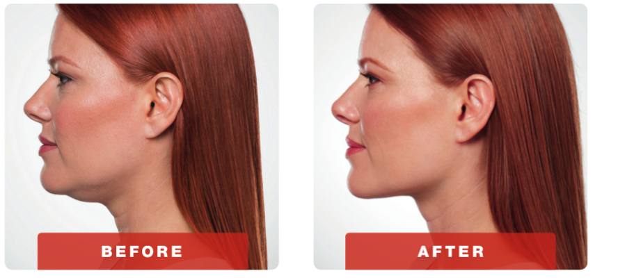 kybella-before-and-after.png