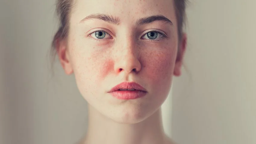 FOREO_MYSA_Rosacea_171215-850x477.jpg