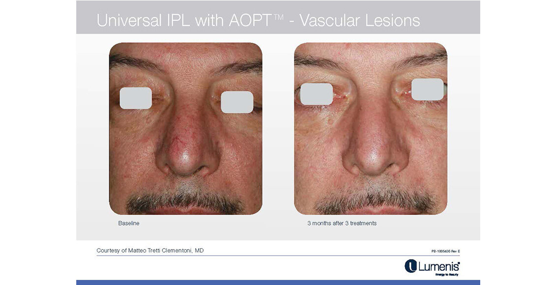 M22-Before-and-after-IPL-Vascular-Lesions-Facial-VeinsResults-photos-Page-047.jpg