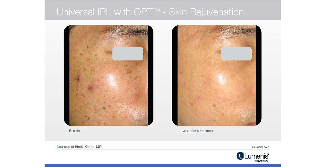 Before-and-after-results-sun-damage-IPL-M22-Module-6-NEW.jpg