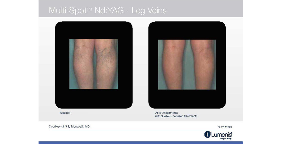 Before-and-after-results-leg-veins-M22-Module-6-NEW.jpg