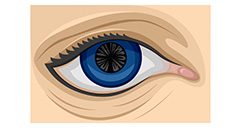 Cortical Cataract