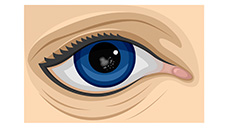 Posterior Capsular Cataract