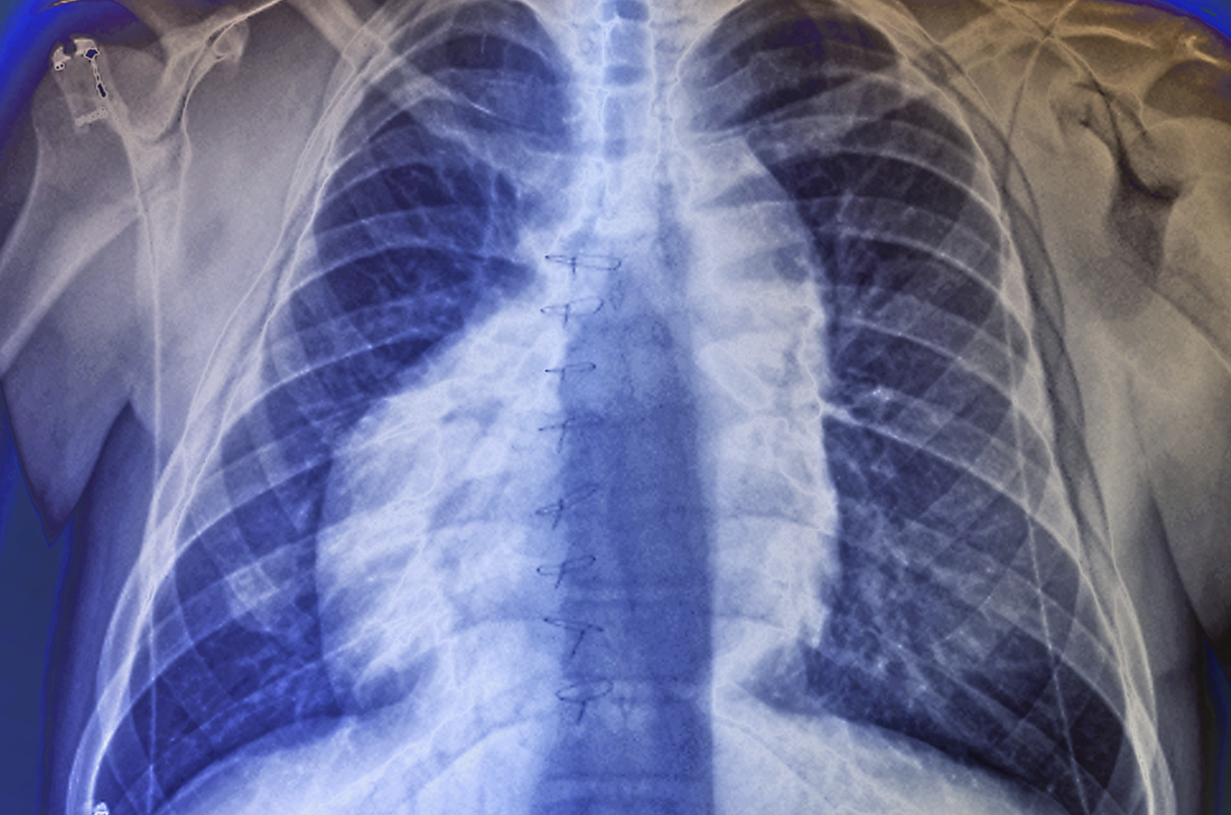 May 2022: Dan talks about latest L-R patterning work