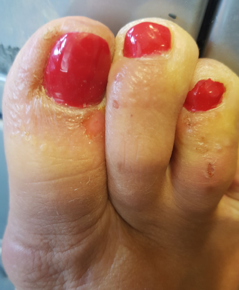 Uñas de gel, ¿algún problema? — Dermothèque