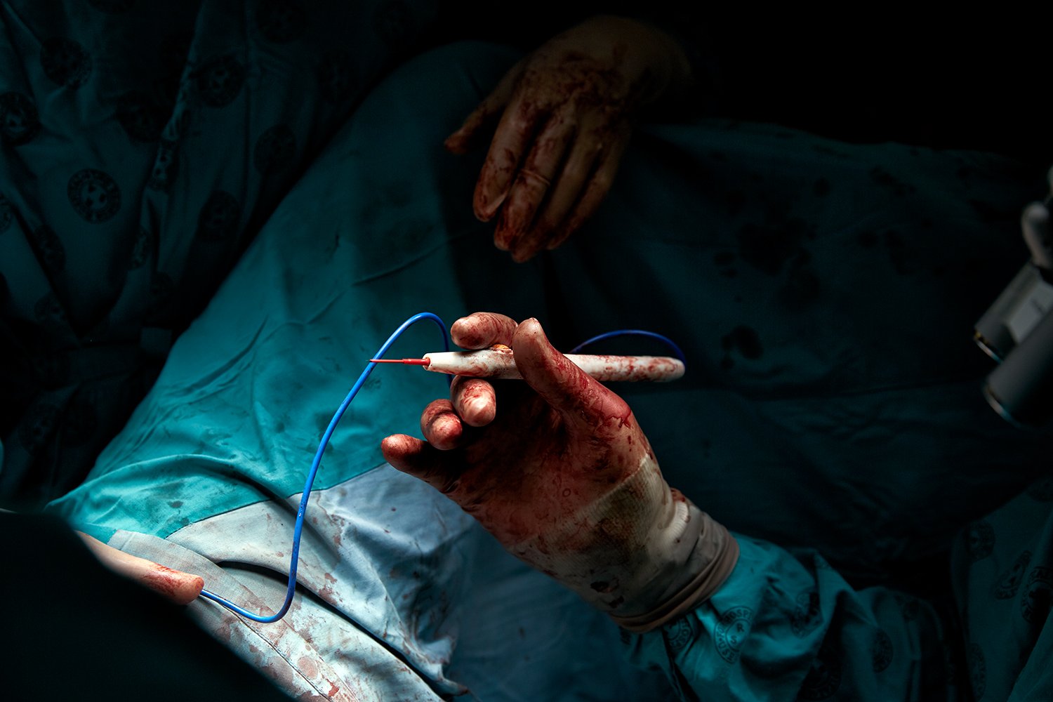  The right hand belonging to Dr. Kevin Adams, during the five-and-half hour gender-affirming surgery of Chedino, Groote Schuur Hospital, Cape Town, 2017.  Two teams of surgeons worked on Chedino during the procedure: one team focused on the "top" sur