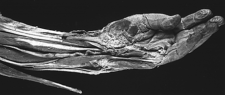 Abductor Digiti Minimi (manus)