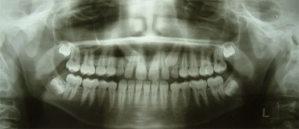 Impacted-Canines-02.jpg
