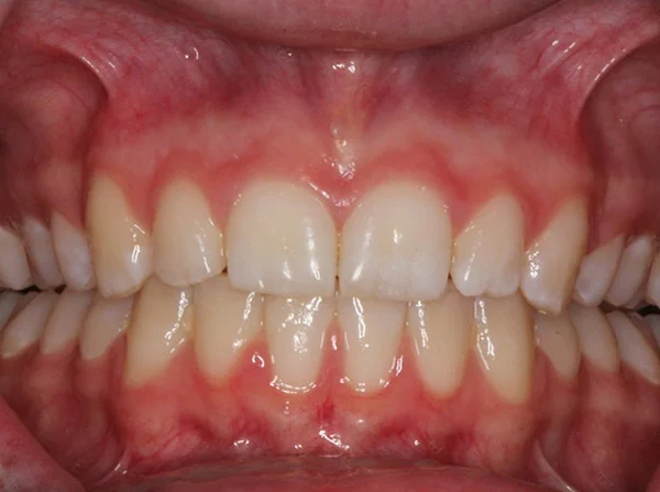 Deep-Overbite-01.jpg