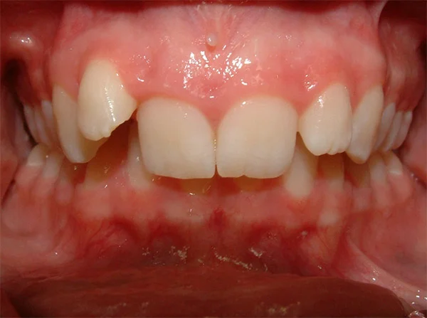 Deep-Overbite-02.jpg