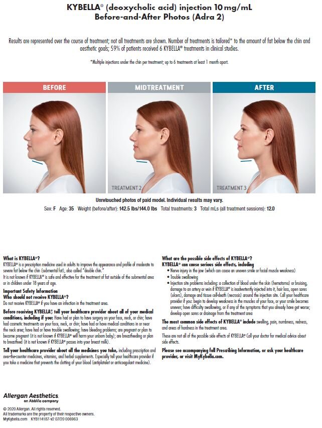Kybella - Before and After - Adra.jpeg