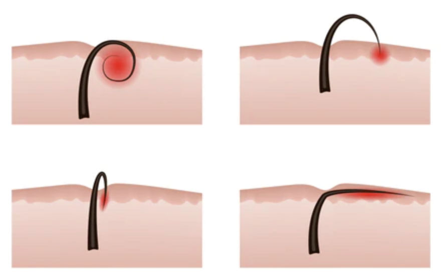 WHAT ARE INGROWN HAIRS? — Helios Health & Beauty