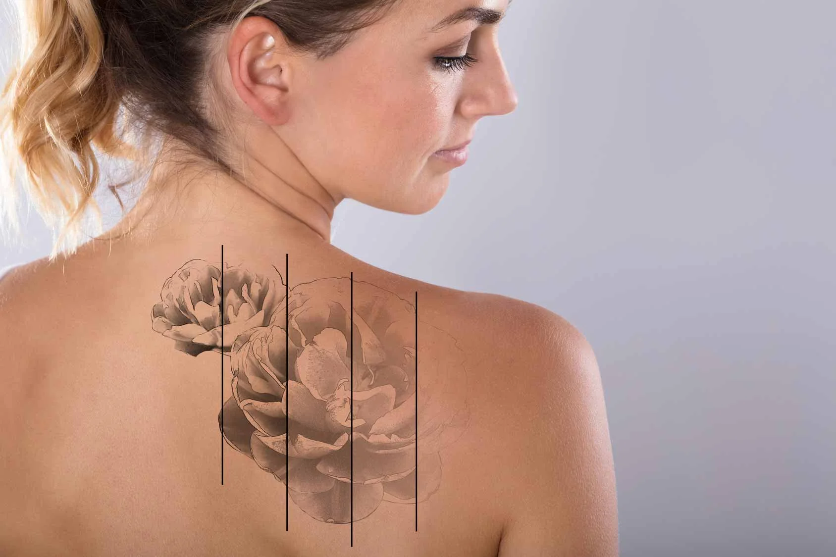 Tattoo Entfernung Schonend Und Effizient Bei Marina Hofmann Marina Hofmann