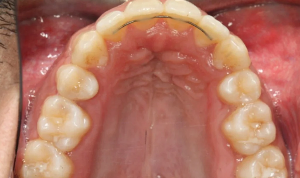 Fixed retainers