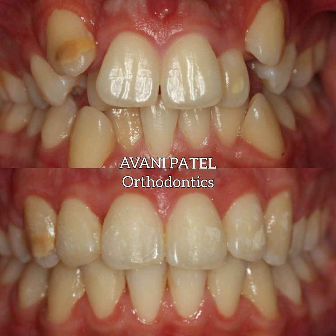 A lovely result for a lovely patient 😁. This young man was incredibly shy when he first came to see me and over the course of his treatment his confidence grew and his smile improved. 
His treatment involved fixed appliances with 4 premolar extracti