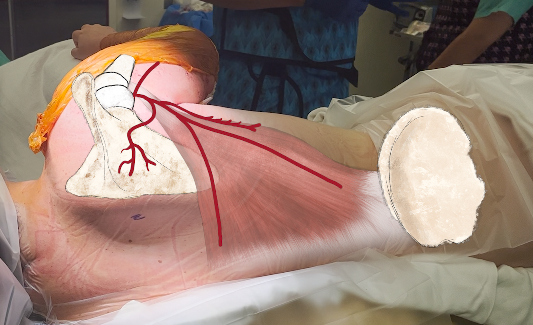 Surgical — Michael Boctor Surgical — Michael Boctor