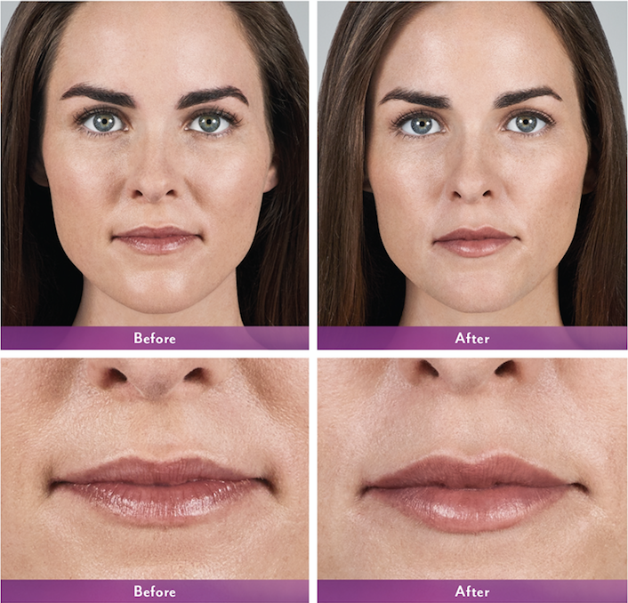 Volbella to add volume to lips