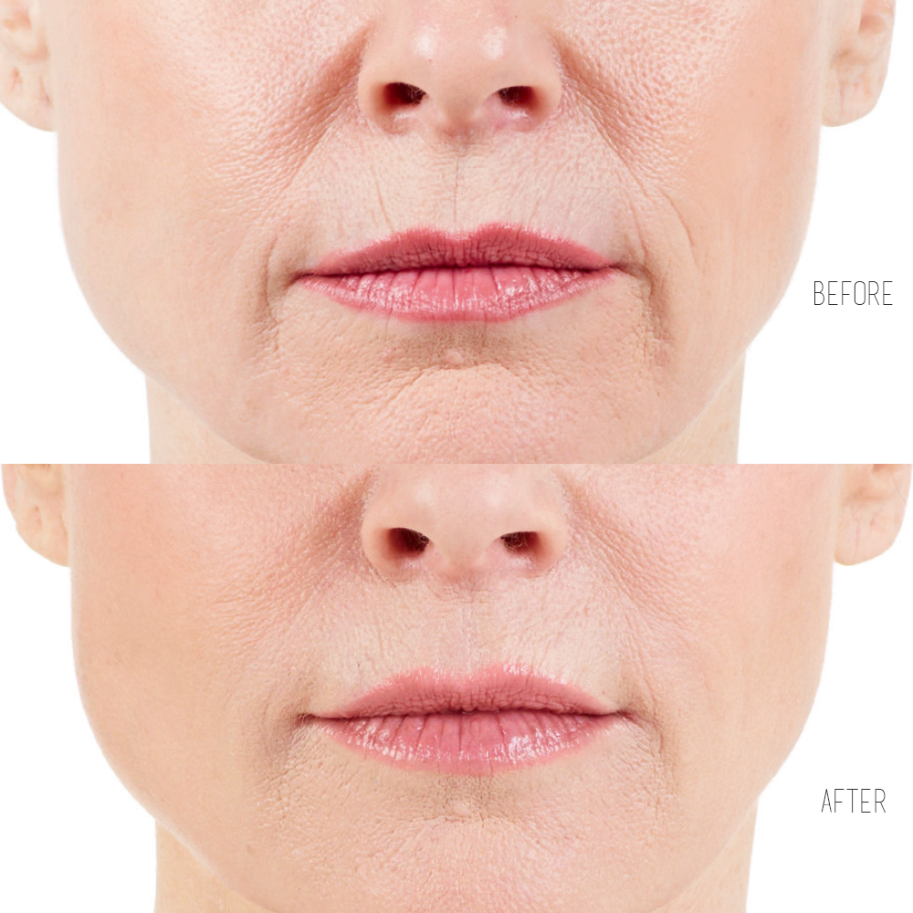 ultra xc to smooth wrinkles around mouth