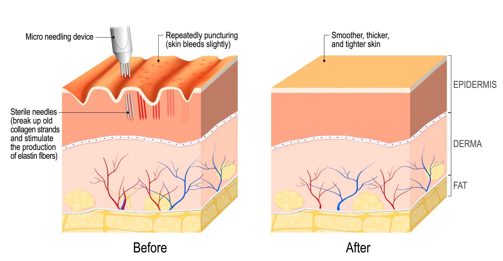 Embrow-Beauty-Dermapen-Micro-Needling-Therapy.jpg