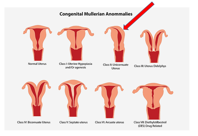 (Photo cred: http://www.momjunction.com/articles/uterine-abnormalities-during-pregnancy_00398428/?ref=content/
