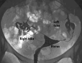 Normal HSG with a full uterus and two open fallopian tubes. Photo credit: here