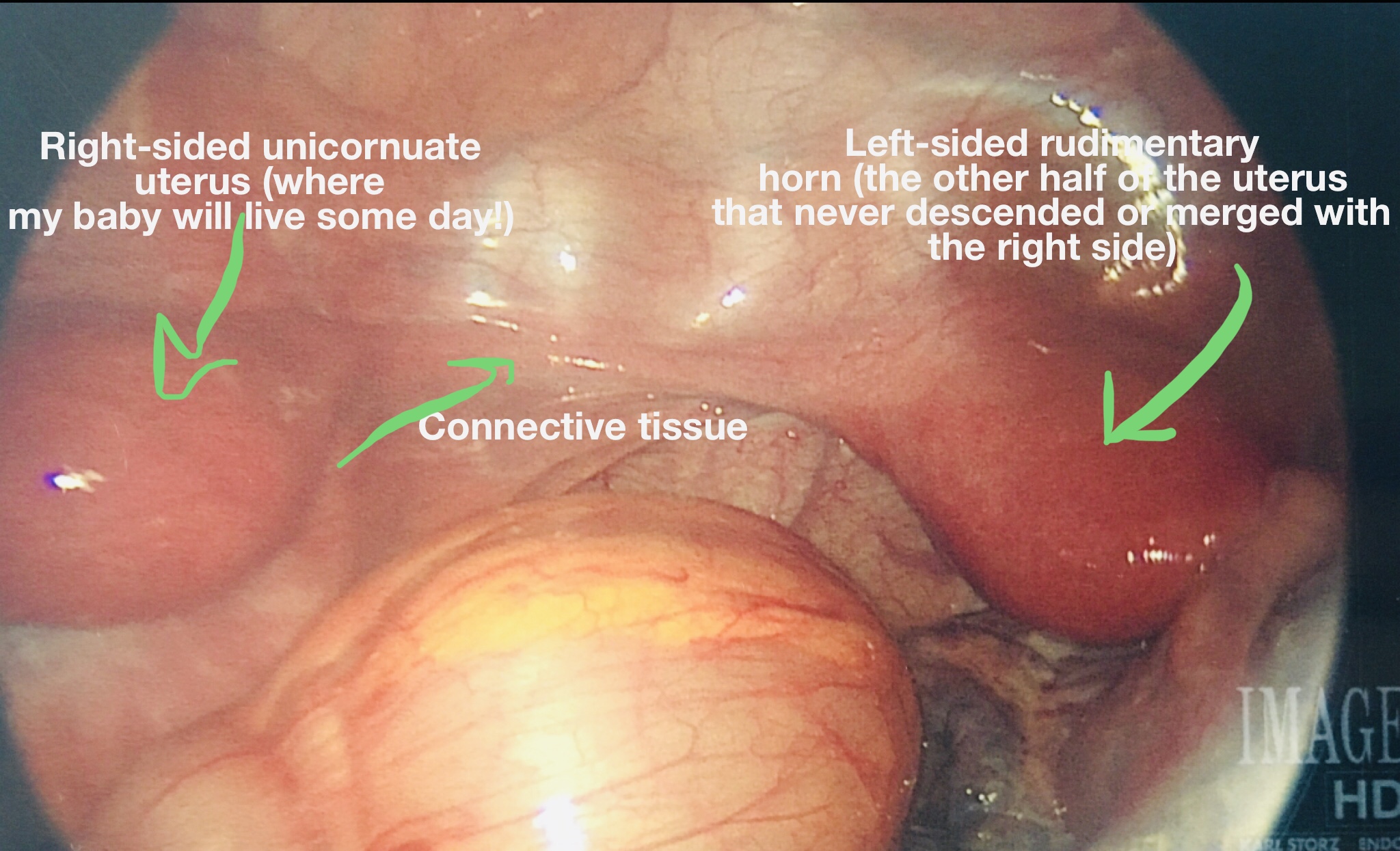 Taken from my laparoscopic surgery in May 2018.