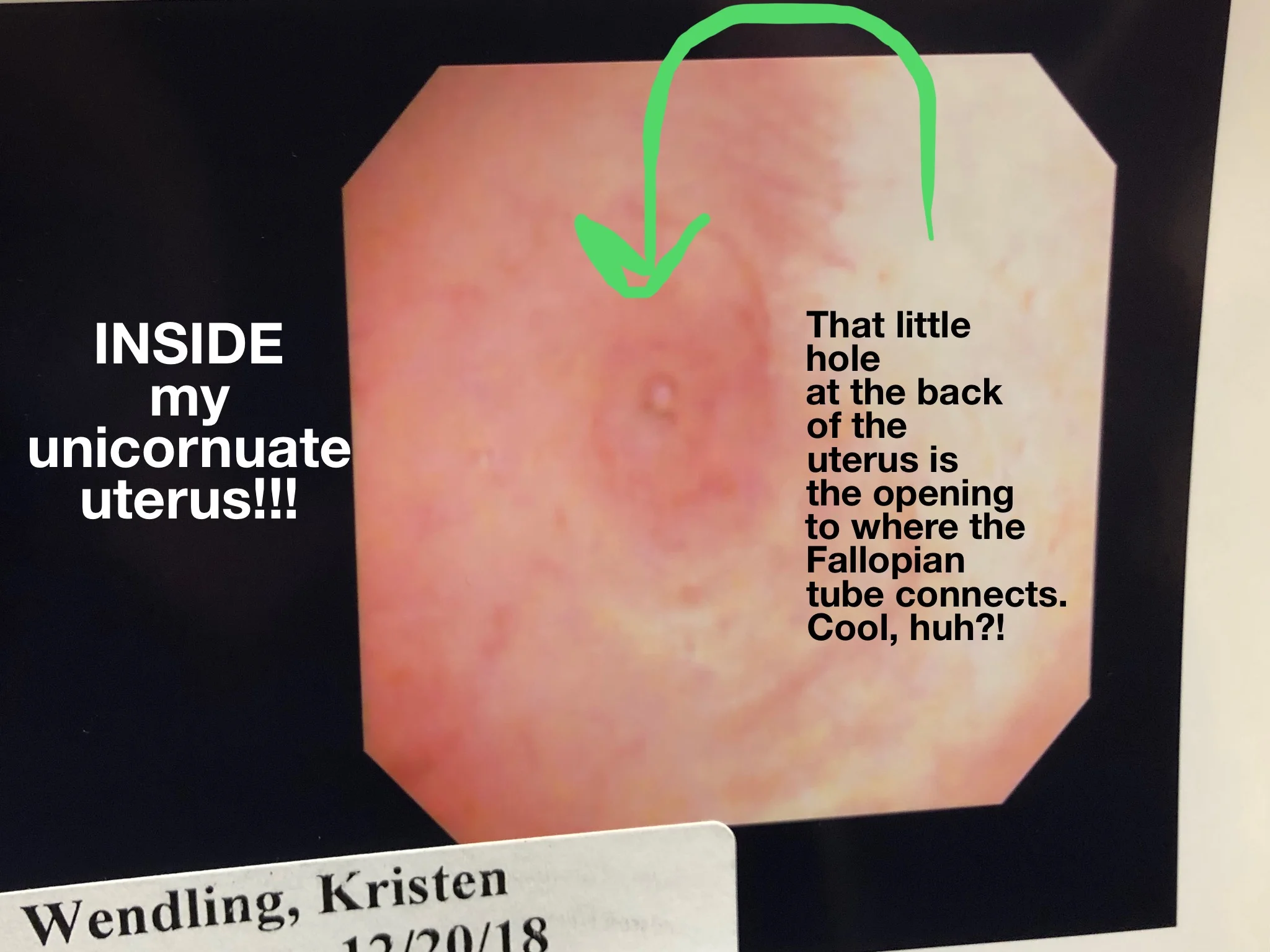 An image taken during my office hysteroscopy on 12/20/18.