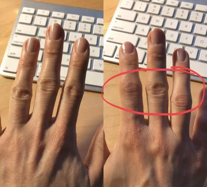 Can you tell a difference between my left hand (left) and right hand (right)? My right hand is flaring today, and the middle joints of the three middle fingers are swollen and stiff. Ouch!