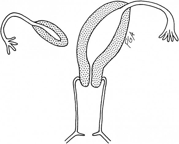 This is a drawing of a unicornuate uterus (right) connected to one ovary with a rudimentary horn connected to the other ovary (left). This is what I have, except mine is flipped (right UU with left horn). Photo credit: here