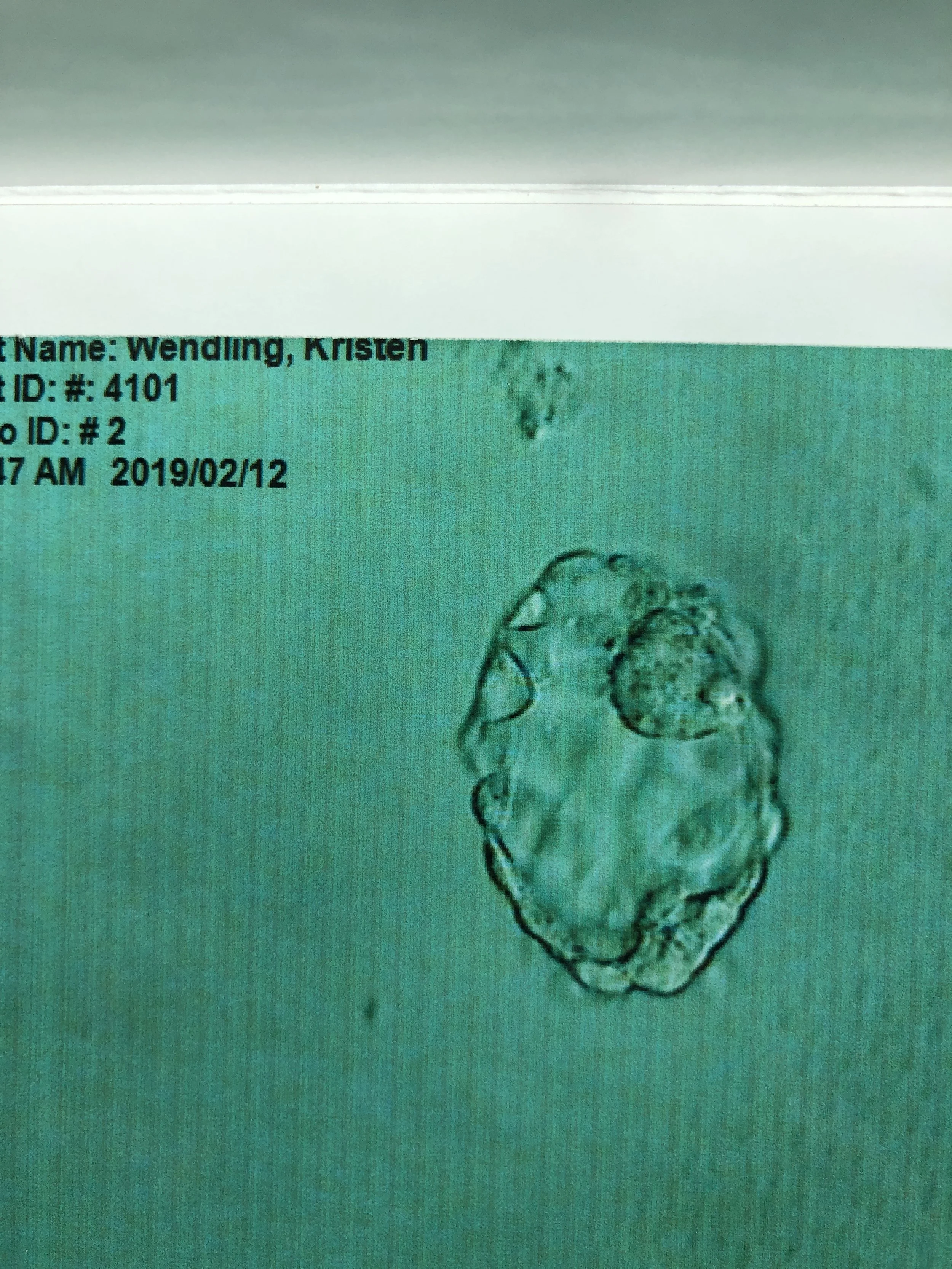 Our “child’s” first picture! The small mass of cells in the upper right corner will become the baby. The rest will become the placenta. Holy wow!