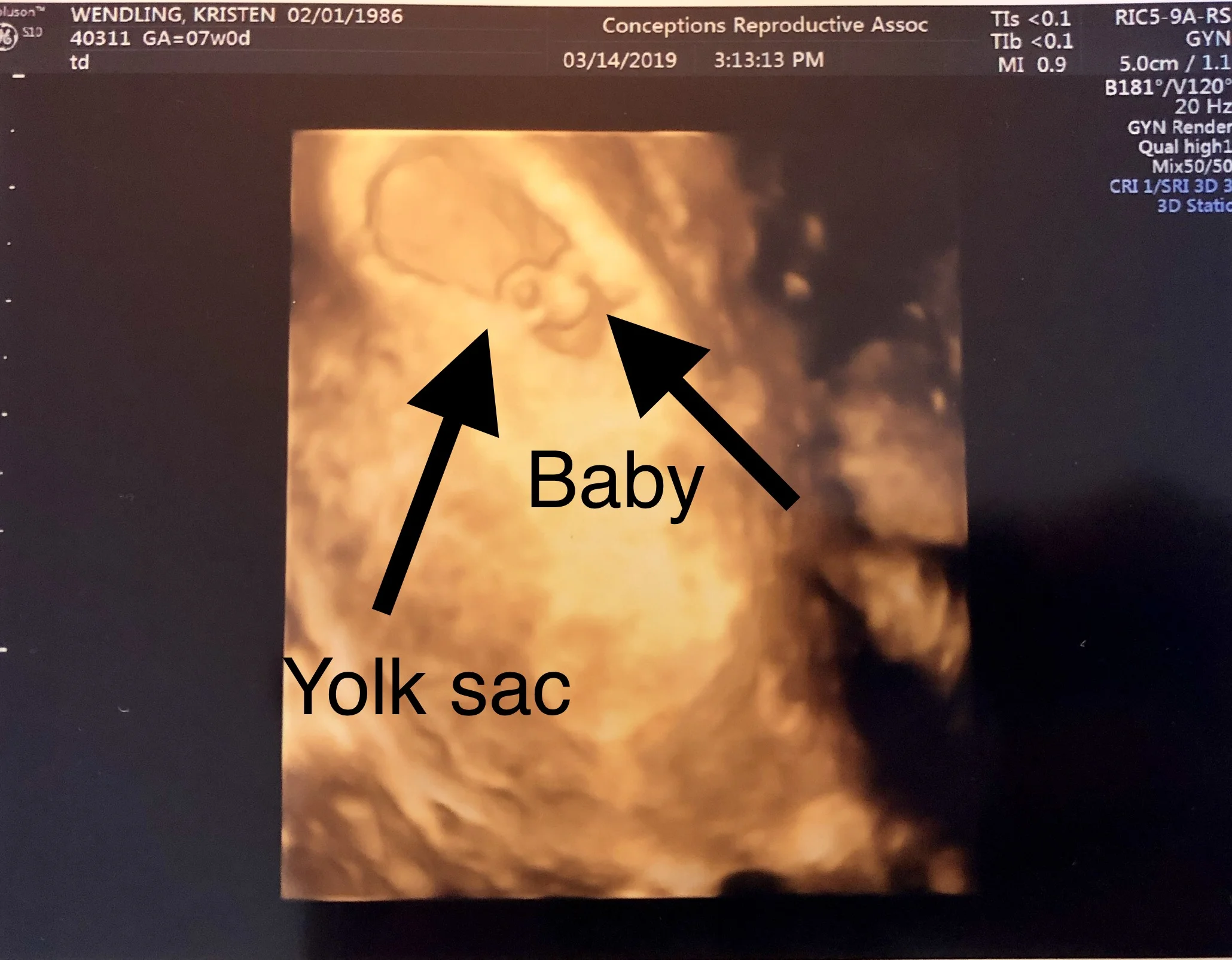 3D ultrasound.jpg