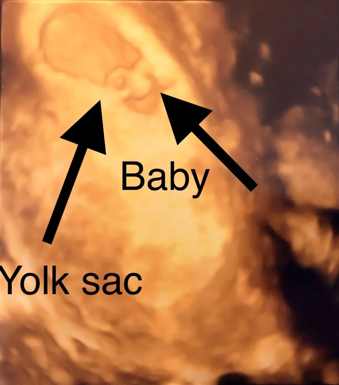 Pregnancy: 7 week ultrasound and gender reveal