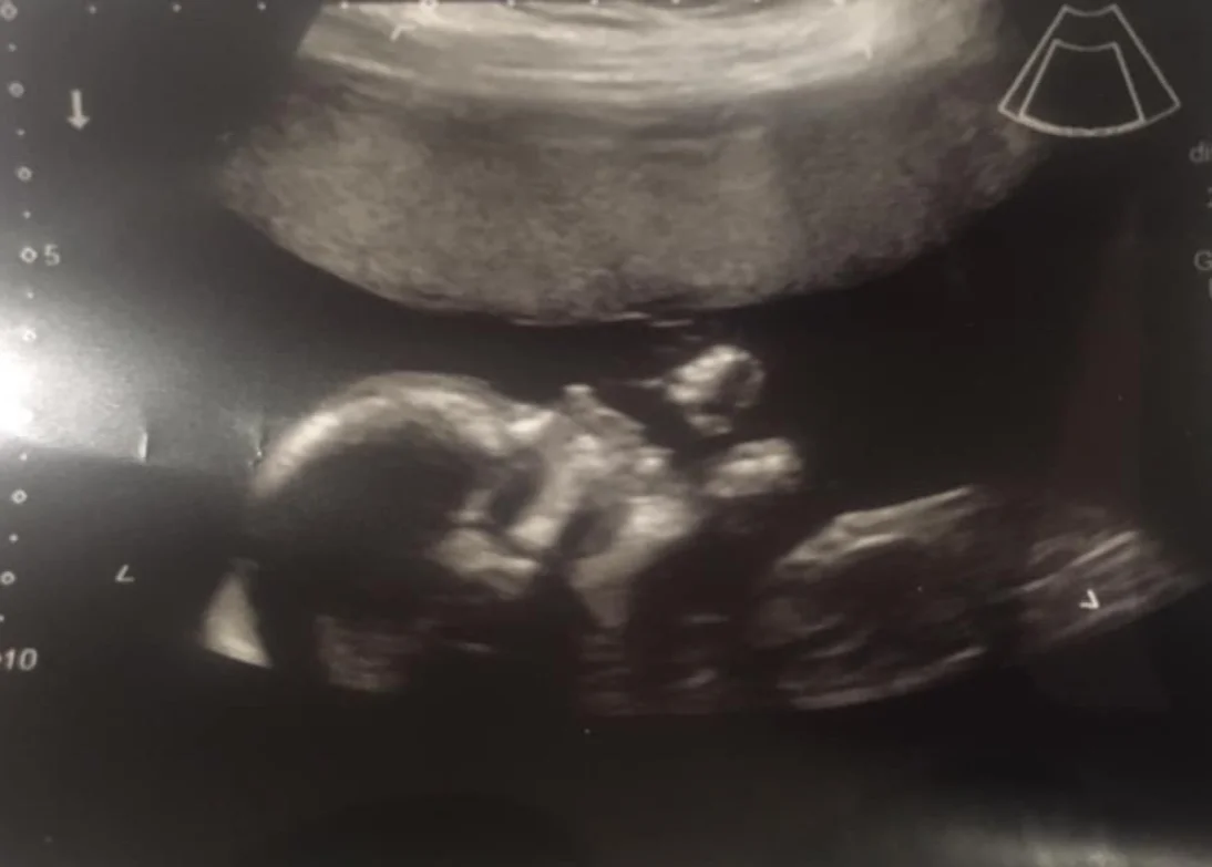Guest Writer Wednesday: Rachel's Unicornuate Uterus Story