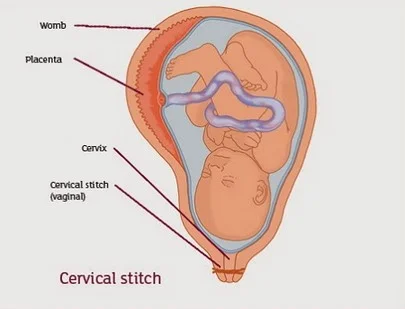 The Cerclage!