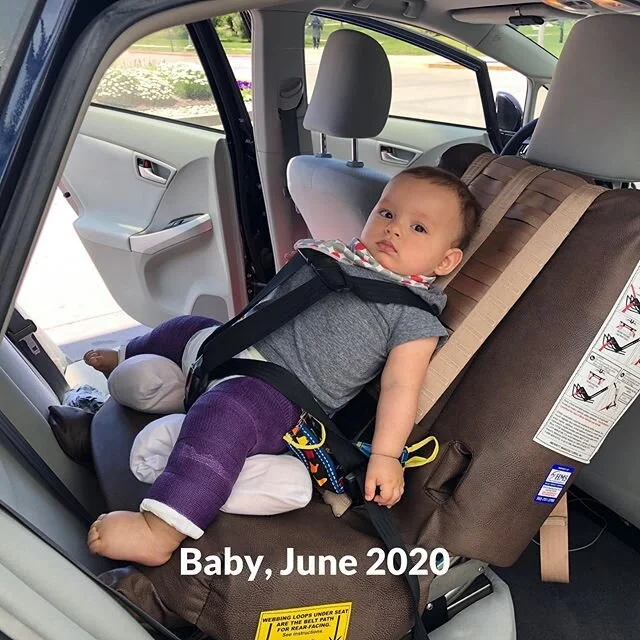 Baby boy has hip dysplasia just like me. ⁣
⁣
Picture 1: Baby boy, June 2020⁣
Picture 2: me, June 1986⁣
⁣
Poor thing had nearly all the risk factors: family history, breech (for the majority of the pregnancy), first born (because the uterus is smaller