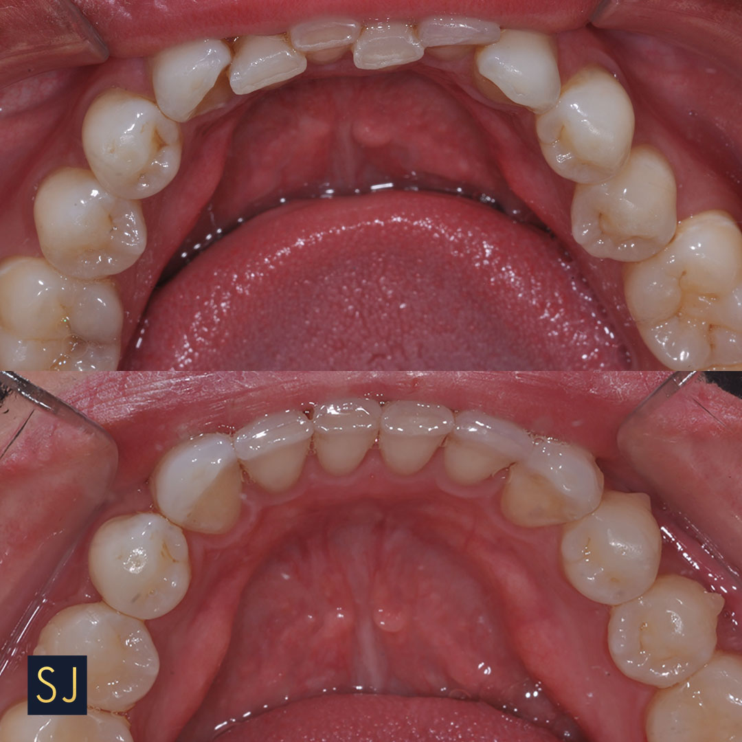 the lower incisors were straightened out