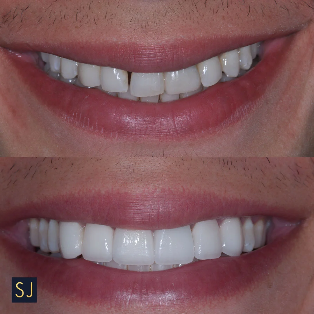 before after smile.jpg