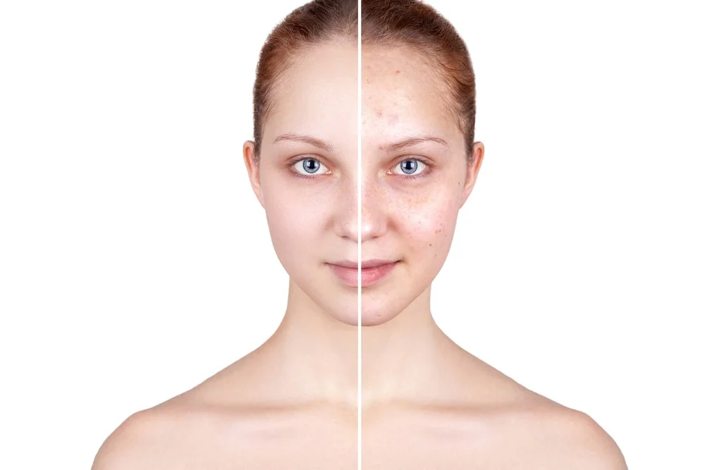 Acne/Problematic Skin
