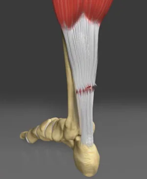 achilles-tendon-rupture.jpg