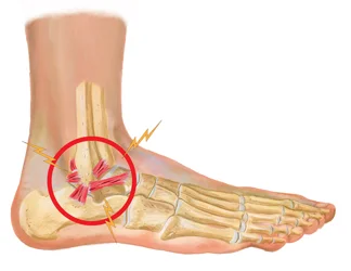 Ankle-Ligament-Injury.jpg