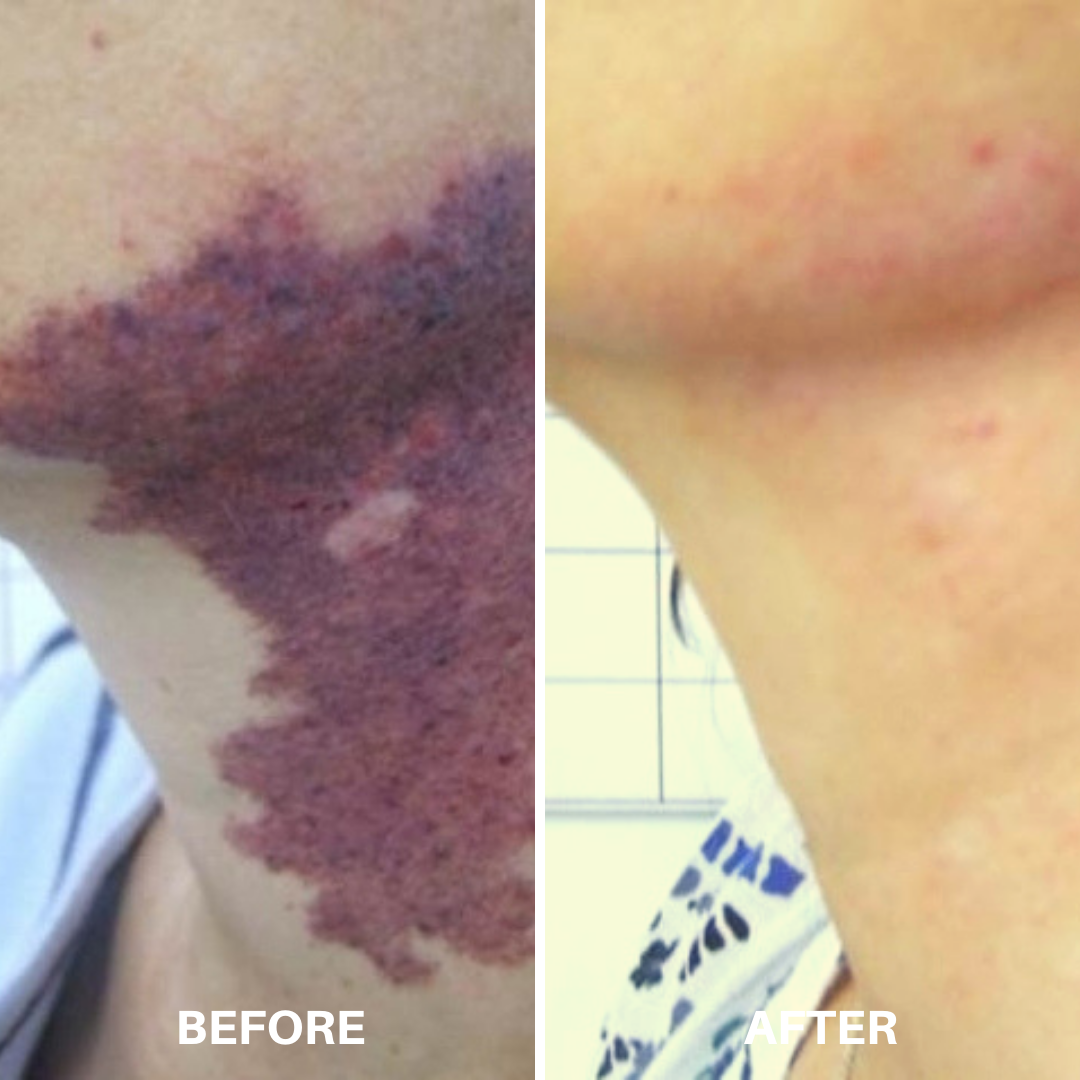 Living With Vascular Lesions — Bem Estar