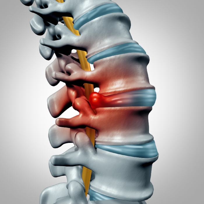 Herniated-Disk.jpg